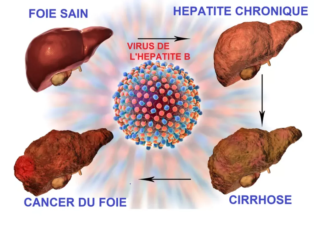 Hépatite b traitement naturel