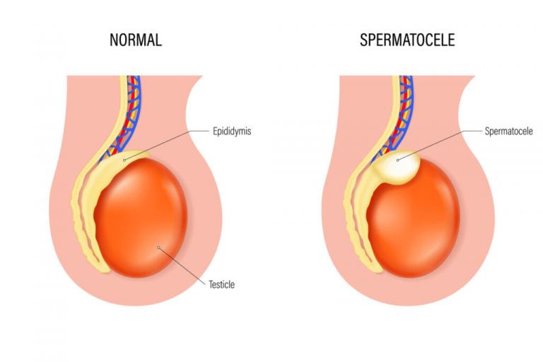 Spermatocèle solution naturelle