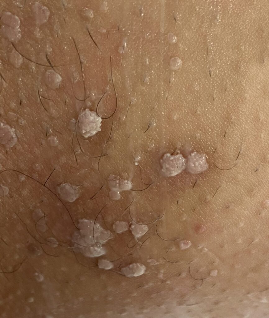 Les verrues génitales traitement naturel