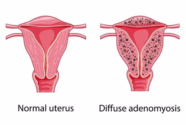 L’adénomyose traitement naturel