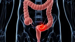 Cancer Colorectal traitement naturel