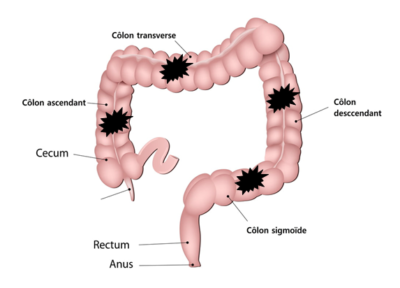 Cancer Colorectal traitement naturel