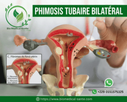 Phimosis tubaire bilatéral traitement naturel