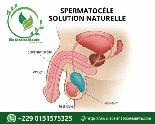 Spermatocèle solution naturelle