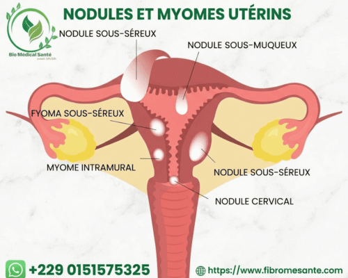 Fibrome Sous-Muqueux Et Fertilité : Définition, Causes Et Solution Naturelle Fibrome sous-muqueux solution naturelle