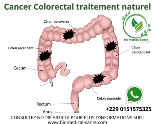 Cancer Colorectal : Définition, Symptômes Et Traitement Naturel Cancer Colorectal traitement naturel