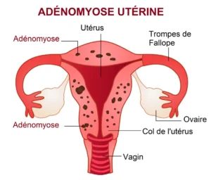 L’Adénomyose traitement naturel