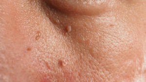 les verrues génitales