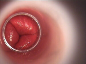 Comment guérir l'hémorroïde naturellement ?