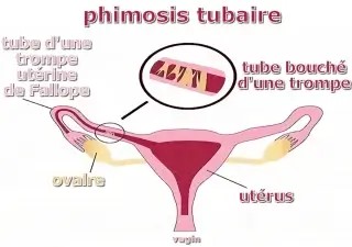 Phimosis tubaire bilatéral traitement naturel