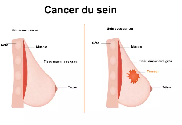 Cancer du sein traitement naturel