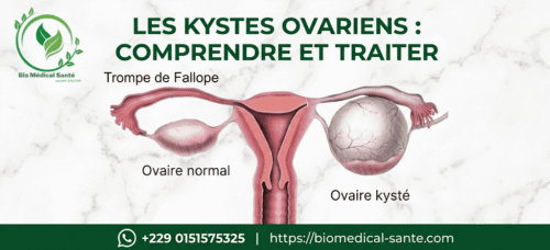 Kyste ovarien traitement naturel