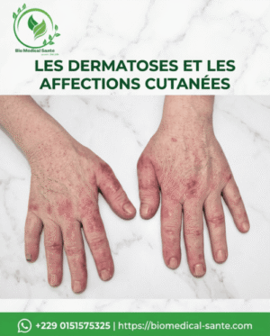 Polymyosite traitement naturel