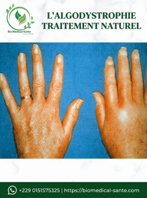 L’algodystrophie traitement naturel