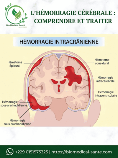 Hémorragie cérébrale traitement naturel