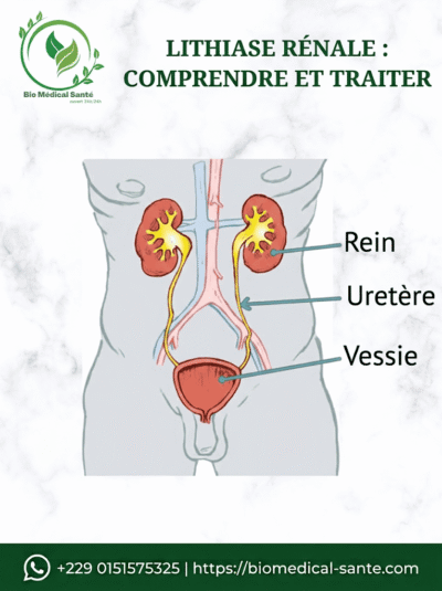 Lithiase rénale traitement naturel