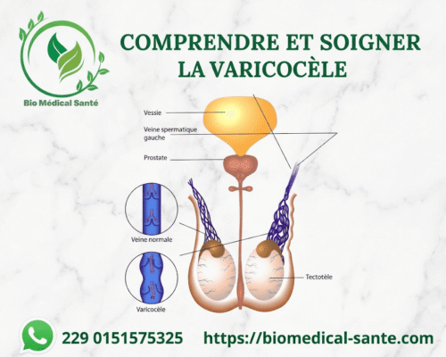 Varicocèle Remède Naturel : Définition, Causes Et Symptômes Varicocèle remède naturel