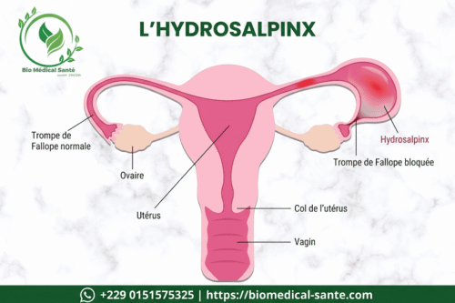 Hydrosalpinx traitement naturel