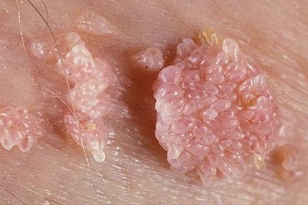 Condylomes solution naturelle