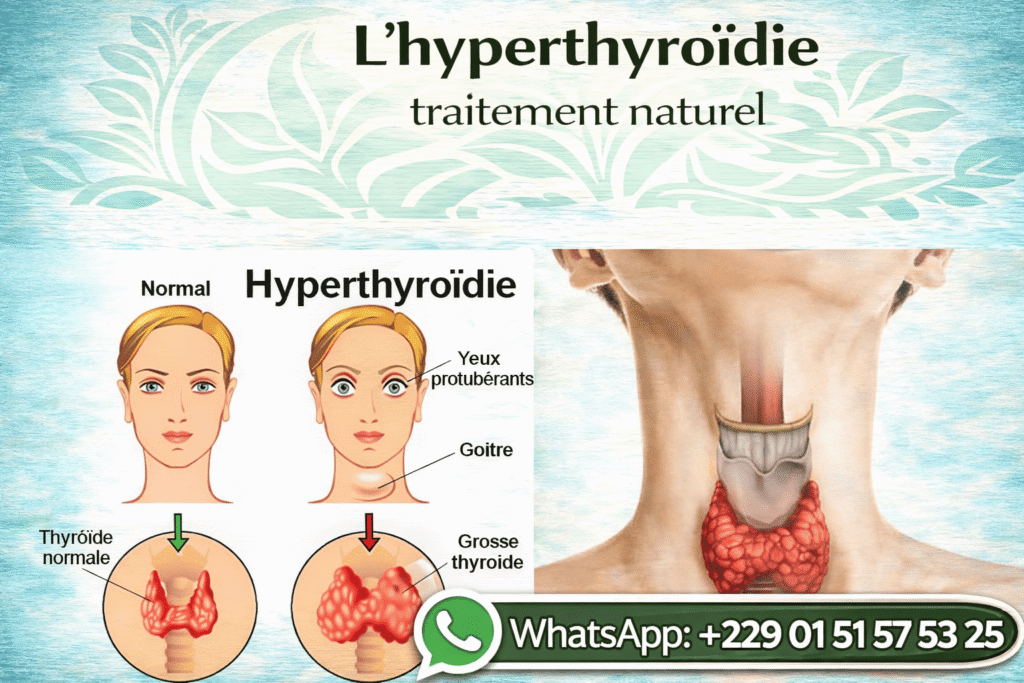 L'hyperthyroïdie traitement naturel