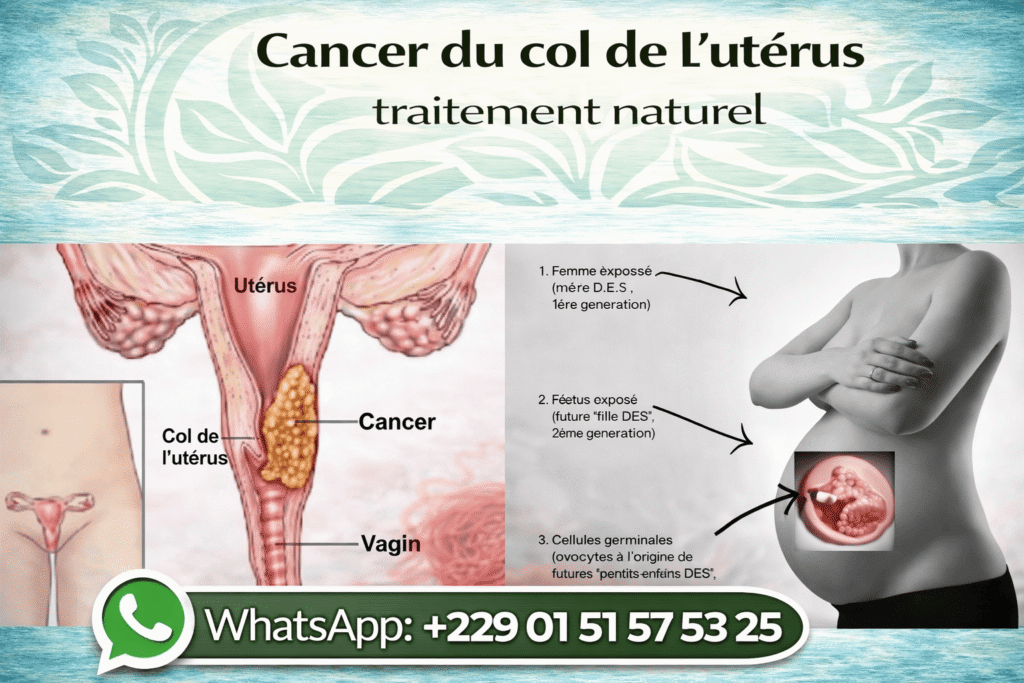 Cancer du col de L'utérus traitement naturel