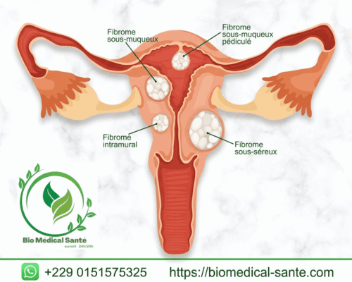 Fibrome traitement naturel
