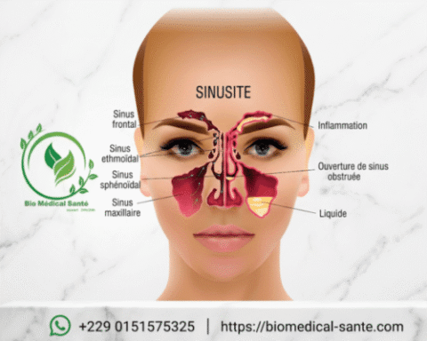 Comment Soigner La Sinusite : Traitement Naturel Par Bio Médical Santé Traitement naturel de la sinusite