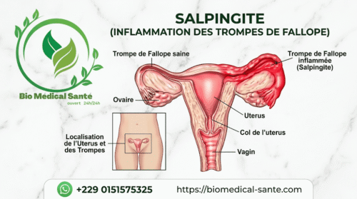 Comment Guérir La Salpingite ? Solution Naturelle Par Bio Médical Santé Comment guérir la salpingite naturellement ?