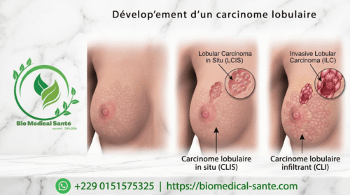 Cancer De Sein Traitement Naturel : Définition, Causes Et Symptômes Cancer de sein traitement naturel