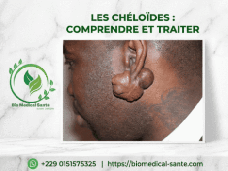 Chéloïdes Traitement Naturel : Définition, Causes Et Symptômes Chéloïdes traitement naturel