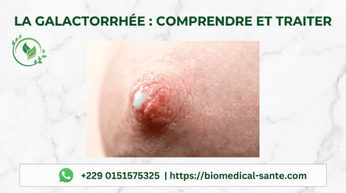 La Galactorrhée Traitement Naturel : Définition, Causes Et Symptômes La galactorrhée traitement naturel