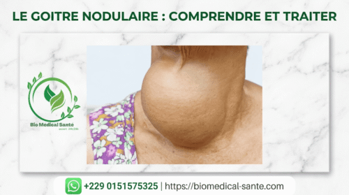 Goitre nodulaire traitement naturel